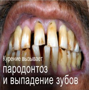 Kazakhstan 2013 Health Effect mouth -diseased teeth, gross